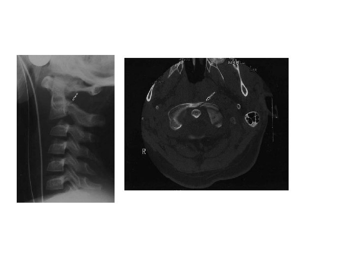 Hagman Fractura tubérculo anterior C 1 