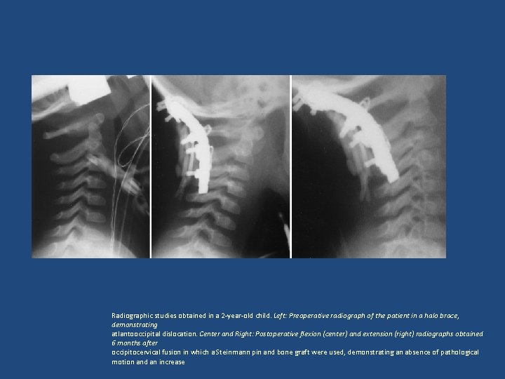 Radiographic studies obtained in a 2 -year-old child. Left: Preoperative radiograph of the patient