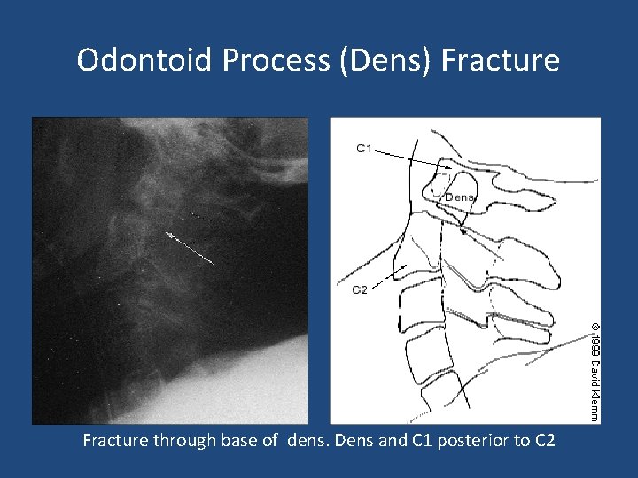 Odontoid Process (Dens) Fracture through base of dens. Dens and C 1 posterior to
