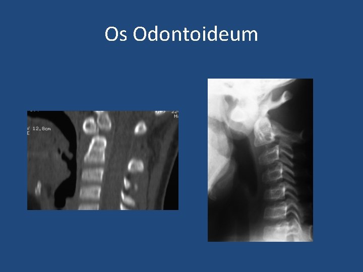 Os Odontoideum 