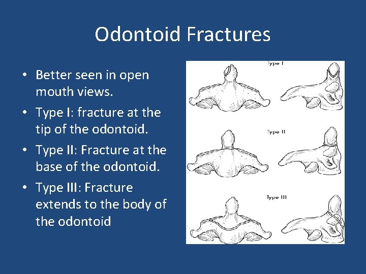 Odontoid Fractures • Better seen in open mouth views. • Type I: fracture at