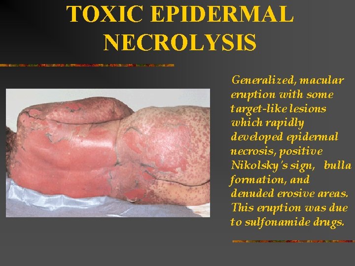 TOXIC EPIDERMAL NECROLYSIS Generalized, macular eruption with some target-like lesions which rapidly developed epidermal
