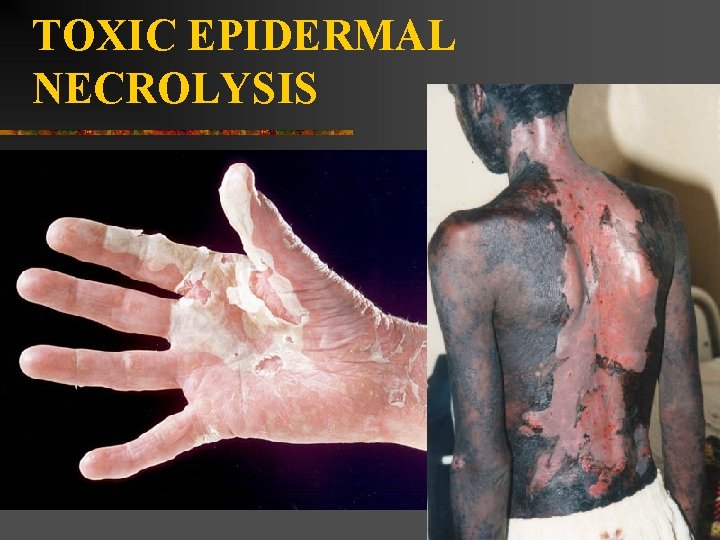 TOXIC EPIDERMAL NECROLYSIS 