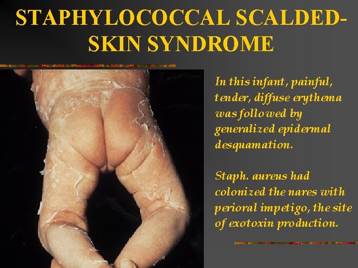 STAPHYLOCOCCAL SCALDEDSKIN SYNDROME In this infant, painful, tender, diffuse erythema was followed by generalized