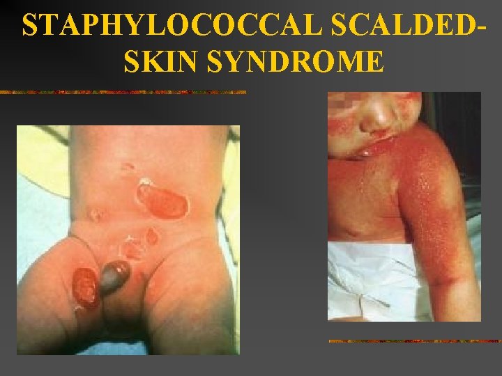 STAPHYLOCOCCAL SCALDEDSKIN SYNDROME 