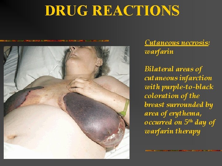 DRUG REACTIONS Cutaneous necrosis: warfarin Bilateral areas of cutaneous infarction with purple-to-black coloration of