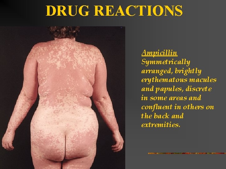 DRUG REACTIONS Ampicillin Symmetrically arranged, brightly erythematous macules and papules, discrete in some areas