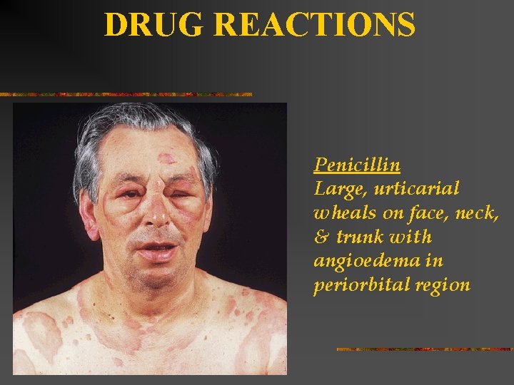 DRUG REACTIONS Penicillin Large, urticarial wheals on face, neck, & trunk with angioedema in