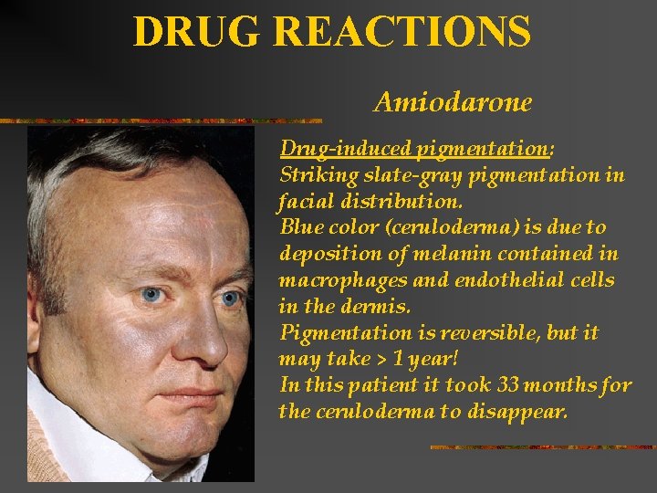 DRUG REACTIONS Amiodarone Drug-induced pigmentation: Striking slate-gray pigmentation in facial distribution. Blue color (ceruloderma)
