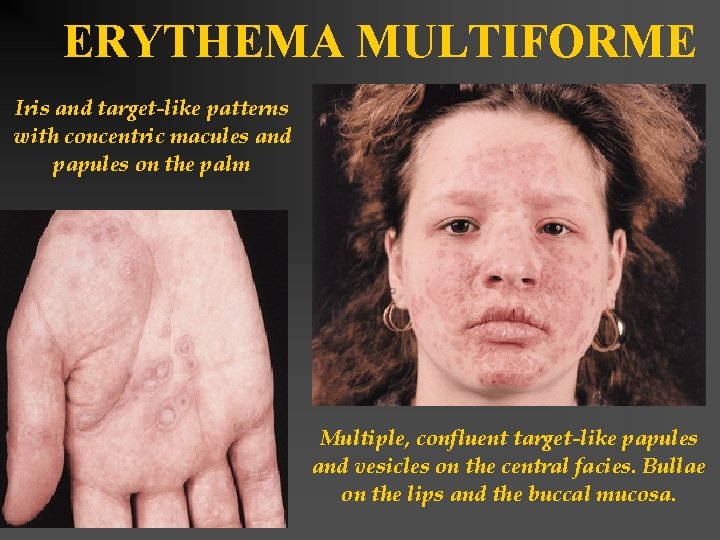 ERYTHEMA MULTIFORME Iris and target-like patterns with concentric macules and papules on the palm