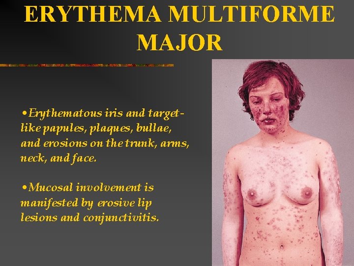 ERYTHEMA MULTIFORME MAJOR • Erythematous iris and targetlike papules, plaques, bullae, and erosions on