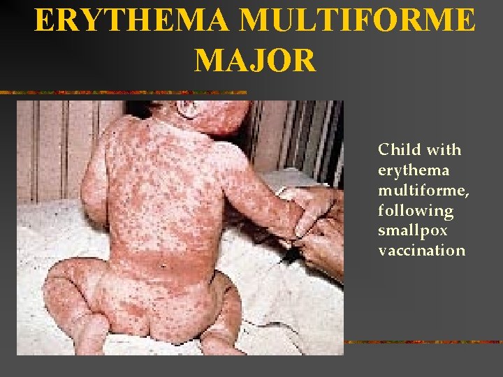 ERYTHEMA MULTIFORME MAJOR Child with erythema multiforme, following smallpox vaccination 