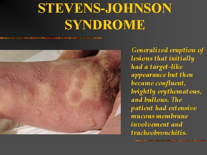 STEVENS-JOHNSON SYNDROME Generalized eruption of lesions that initially had a target-like appearance but then