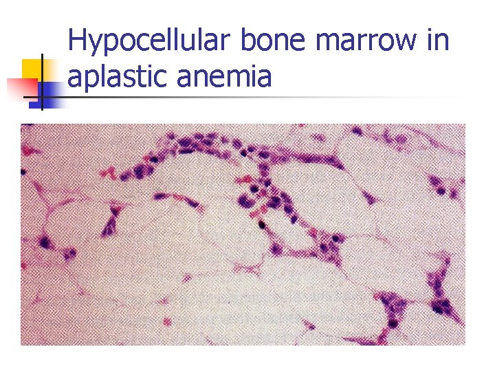 Hypocellular bone marrow in aplastic anemia 