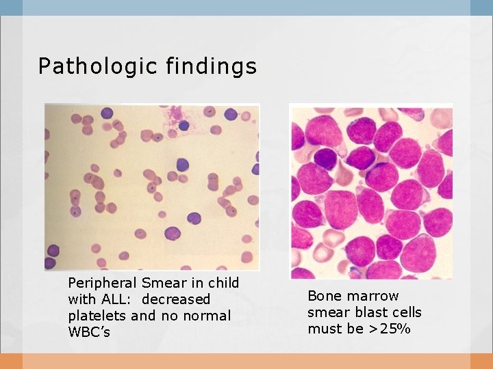 Pathologic findings Peripheral Smear in child with ALL: decreased platelets and no normal WBC’s