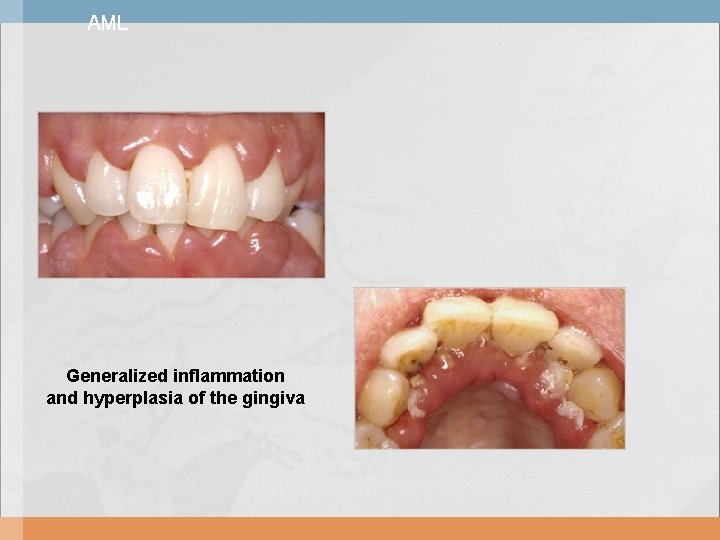 AML Generalized inflammation and hyperplasia of the gingiva 