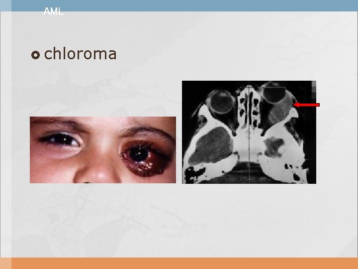 AML chloroma 
