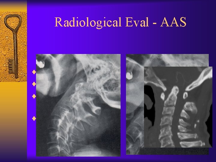 Radiological Eval - AAS ¨ Need flexion lateral. ¨ Normal is 3 mm. ¨
