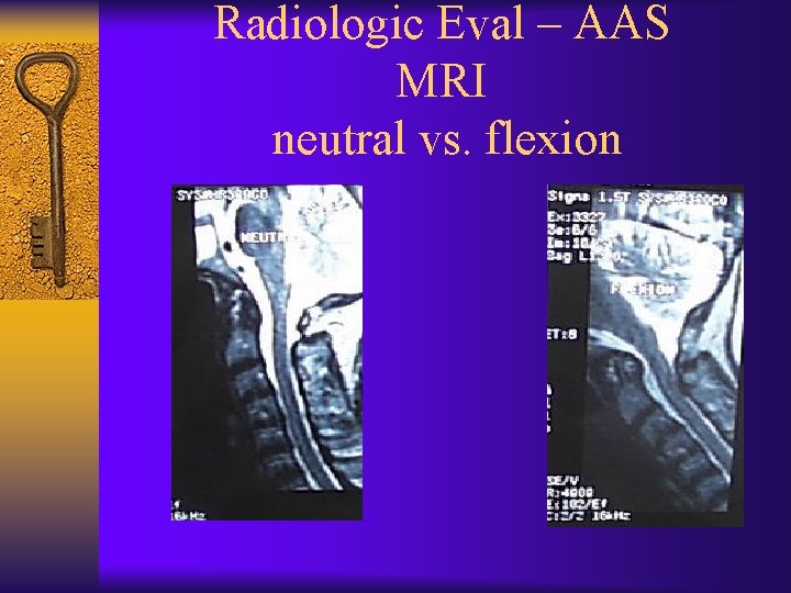 Radiologic Eval – AAS MRI neutral vs. flexion 
