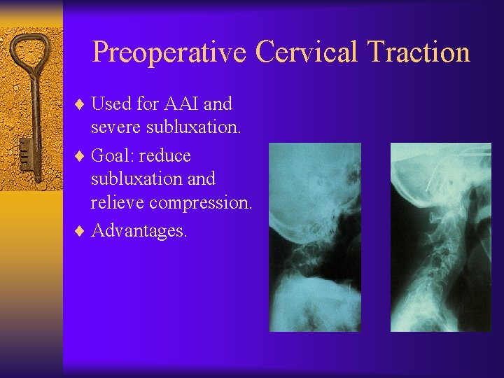 Preoperative Cervical Traction ¨ Used for AAI and severe subluxation. ¨ Goal: reduce subluxation