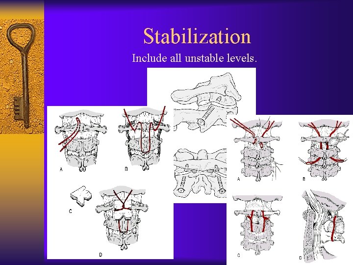 Stabilization Include all unstable levels. 