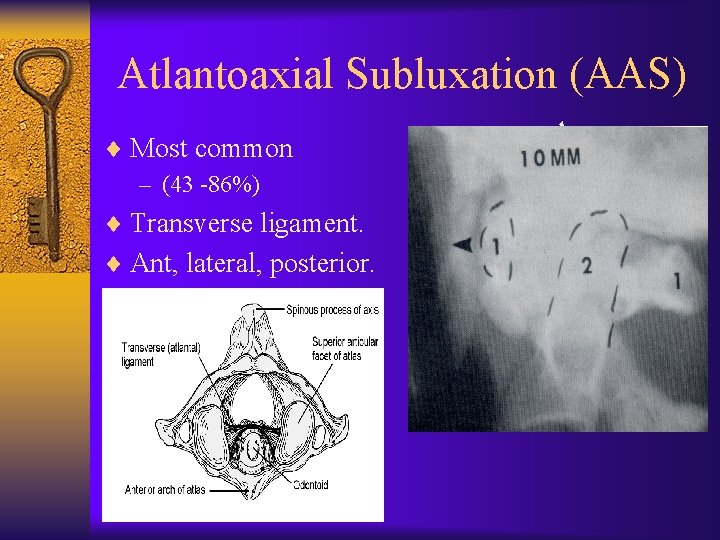 Atlantoaxial Subluxation (AAS) ¨ Most common – (43 -86%) ¨ Transverse ligament. ¨ Ant,