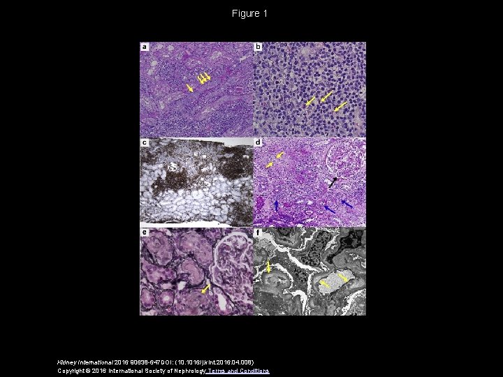 Figure 1 Kidney International 2016 90638 -647 DOI: (10. 1016/j. kint. 2016. 04. 008)