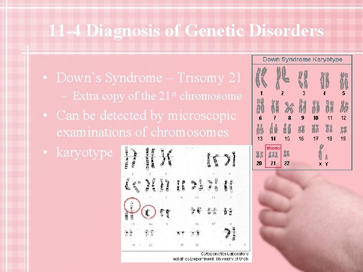 11 -4 Diagnosis of Genetic Disorders • Down’s Syndrome – Trisomy 21 – Extra