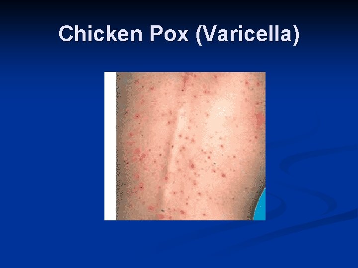 Chicken Pox (Varicella) 
