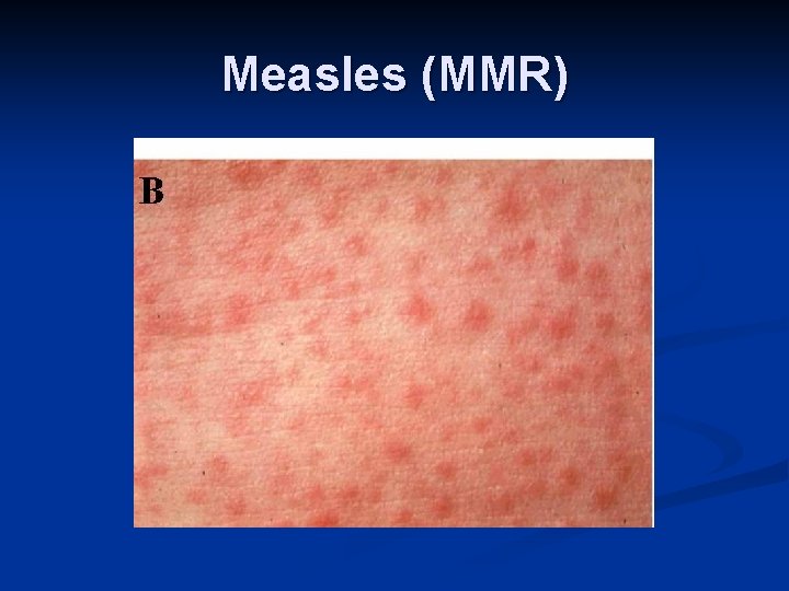 Measles (MMR) 