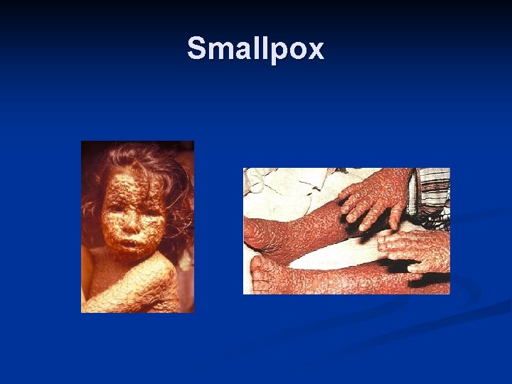 Smallpox 