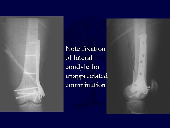 Note fixation of lateral condyle for unappreciated comminution Note fixation of lateral condyle for unappreciated comminution