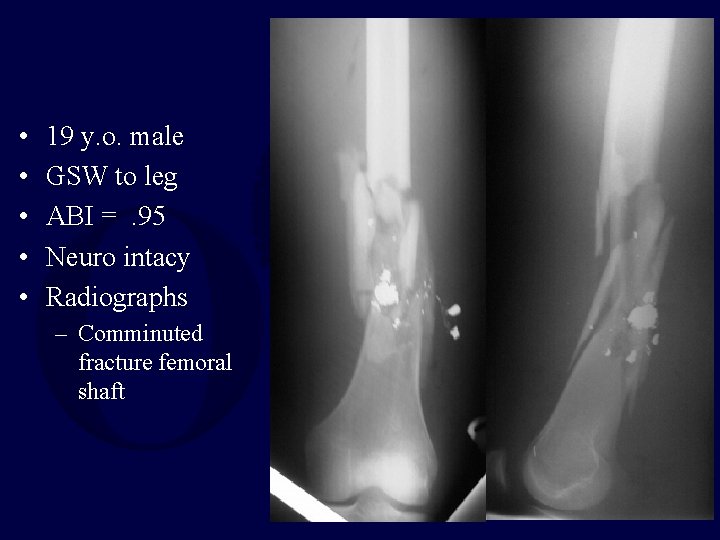 • • • 19 y. o. male GSW to leg ABI =. 95 • • • 19 y. o. male GSW to leg ABI =. 95