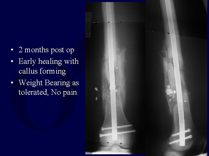 • 2 months post op • Early healing with callus forming • Weight • 2 months post op • Early healing with callus forming • Weight
