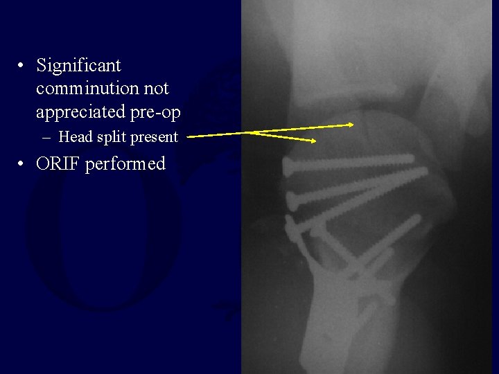 • Significant comminution not appreciated pre-op – Head split present • ORIF performed • Significant comminution not appreciated pre-op – Head split present • ORIF performed