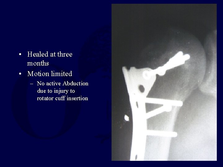 • Healed at three months • Motion limited – No active Abduction due • Healed at three months • Motion limited – No active Abduction due