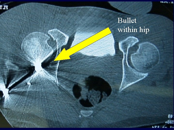 Bullet within hip Bullet within hip