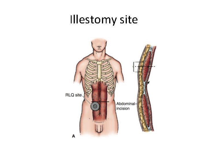 Illestomy site 