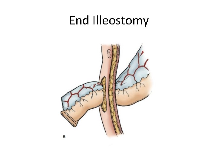 Intestinal Stomas Stoma or ostomy Definition An intestinal