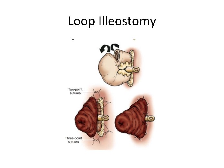 Loop Illeostomy 