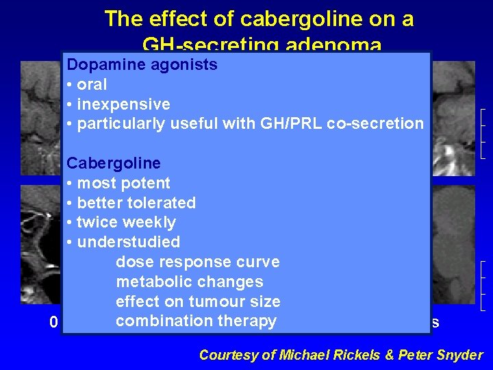 The effect of cabergoline on a GH-secreting adenoma Dopamine agonists • oral • inexpensive