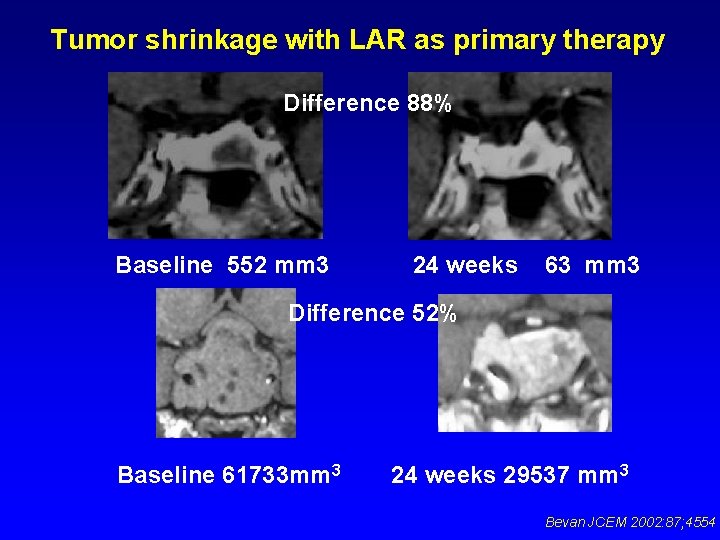 Tumor shrinkage with LAR as primary therapy Difference 88% Baseline 552 mm 3 24