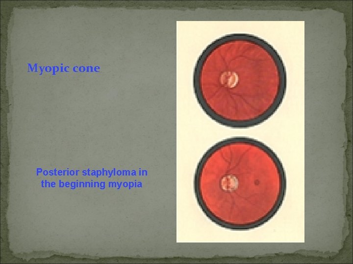 Myopic cone Posterior staphyloma in the beginning myopia 