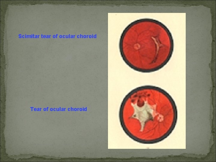 Scimitar tear of ocular choroid Tear of ocular choroid 