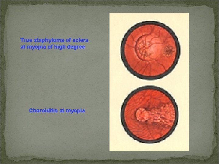 True staphyloma of sclera at myopia of high degree Choroiditis at myopia 