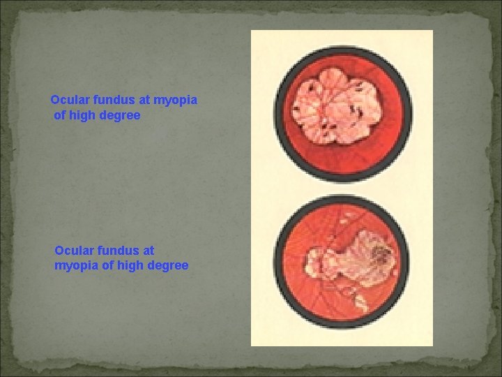 Ocular fundus at myopia of high degree 