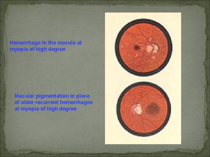 Hemorrhage in the macula at myopia of high degree Macular pigmentation in place of