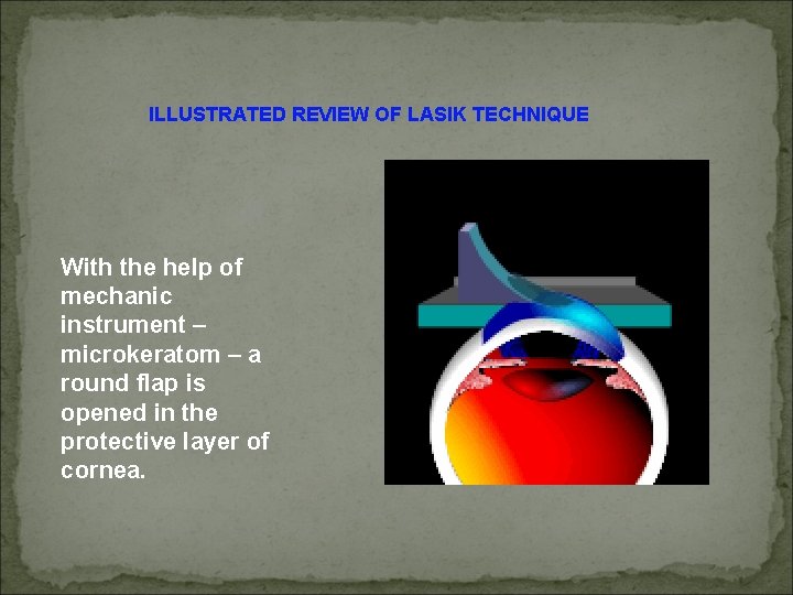 ILLUSTRATED REVIEW OF LASIK TECHNIQUE With the help of mechanic instrument – microkeratom –