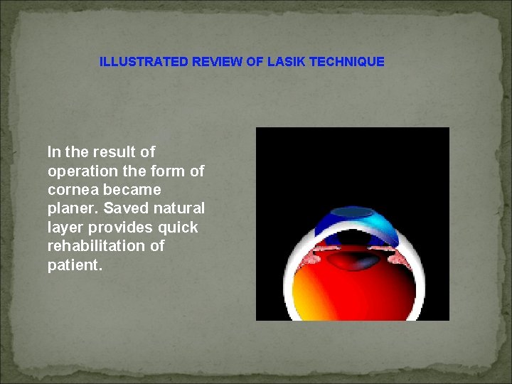 ILLUSTRATED REVIEW OF LASIK TECHNIQUE In the result of operation the form of cornea