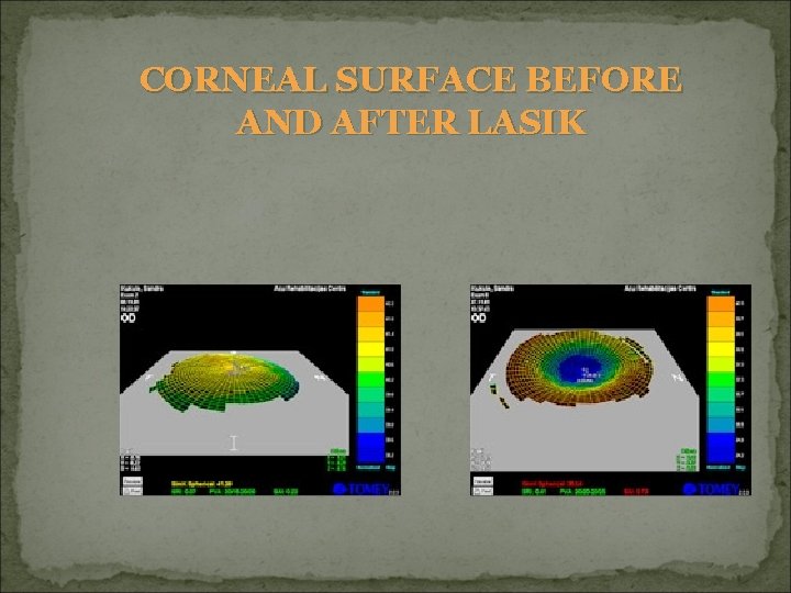 CORNEAL SURFACE BEFORE AND AFTER LASIK 